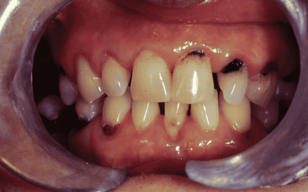 All About Tooth Cavity and Decay