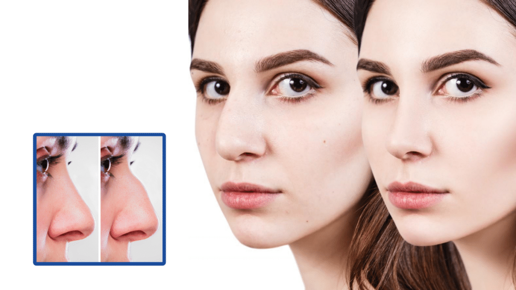 Nose Job Surgery Finding the Perfect Technique for Your Face