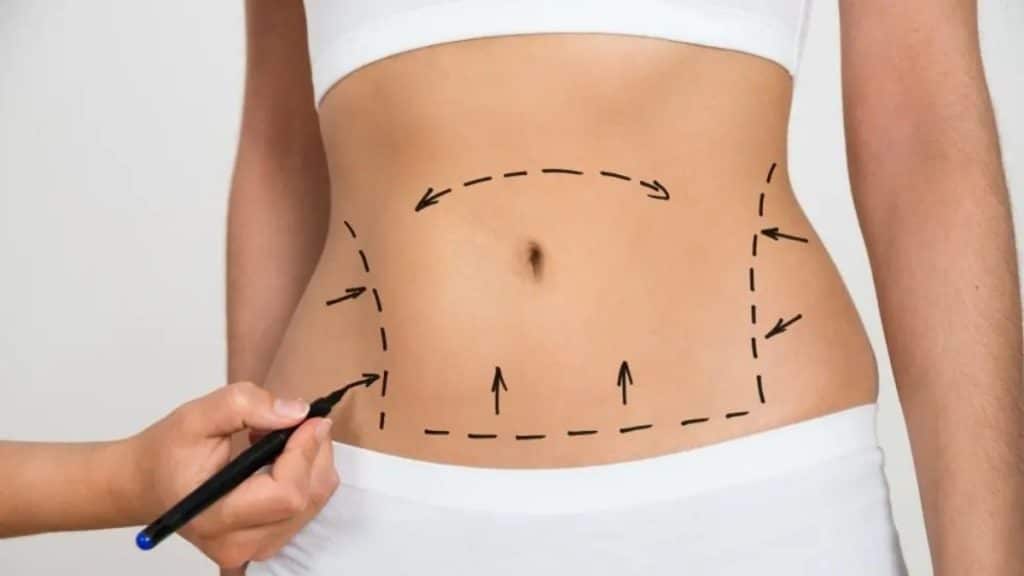 Comprehensive Insight into Tummy Tuck Procedures in Turkey at Celyxmed