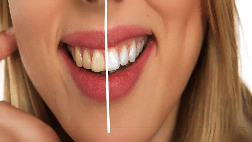 8 Must-Know Benefits of Opting for Teeth Whitening